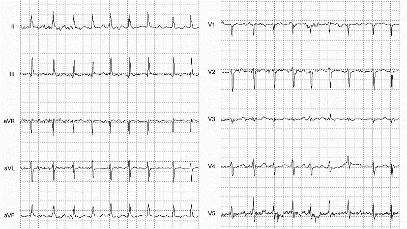 Atrial Fibrillation 12 Lead EKG_fig2